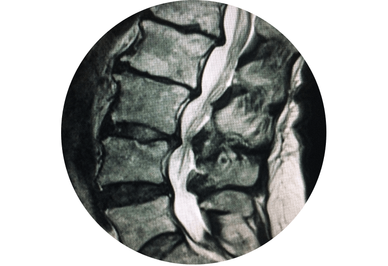 Lumbar Stenosis