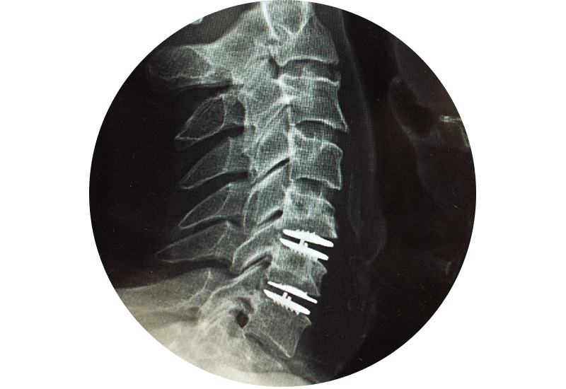 Anterior Cervical Disc Replacement